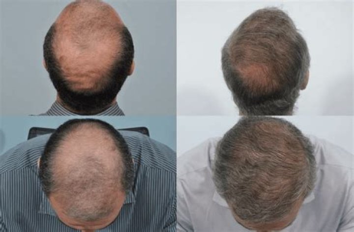 Are hair transplants permanent?