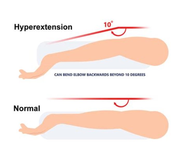 Are hyperextended elbows bad?