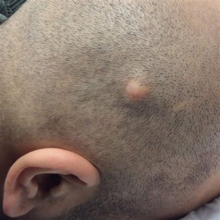 Are pilar cysts painful?