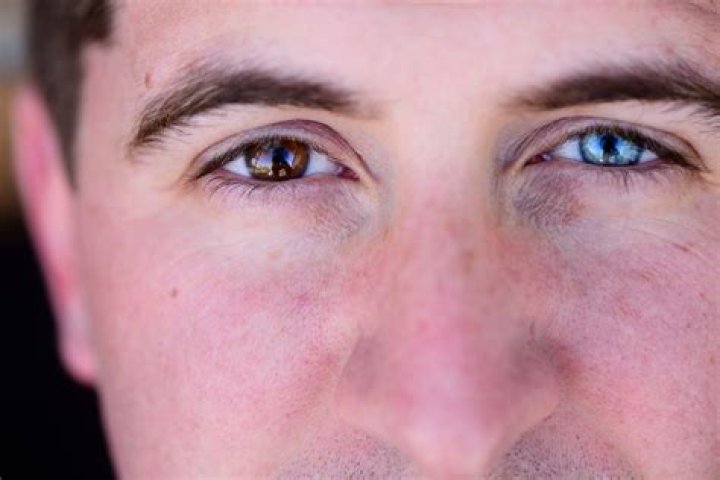 Are two different colored eyes rare?
