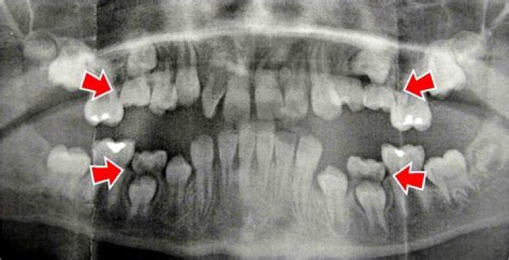 Can an ankylosed tooth be moved?