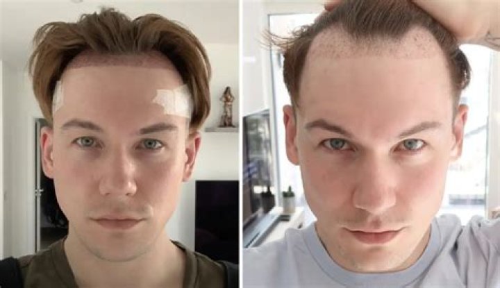 Can hair transplants fall out?