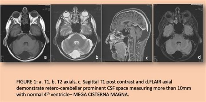 Can mega cisterna magna cause headaches?