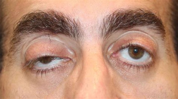Can ptosis cause headaches?