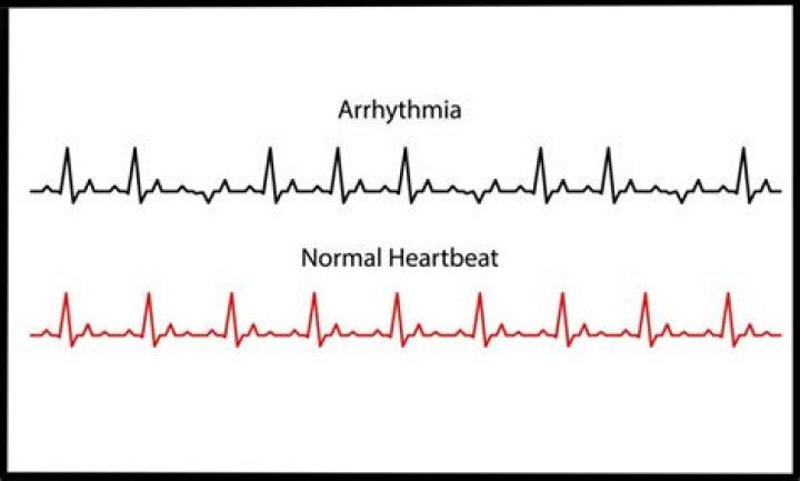 Can stress and anxiety cause heart arrhythmias?