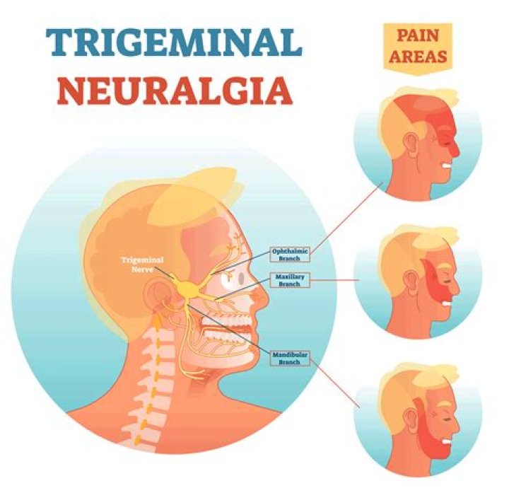 Can trigeminal neuralgia cause ear pain?