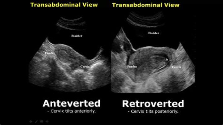 Can uterus change from retroverted to anteverted?