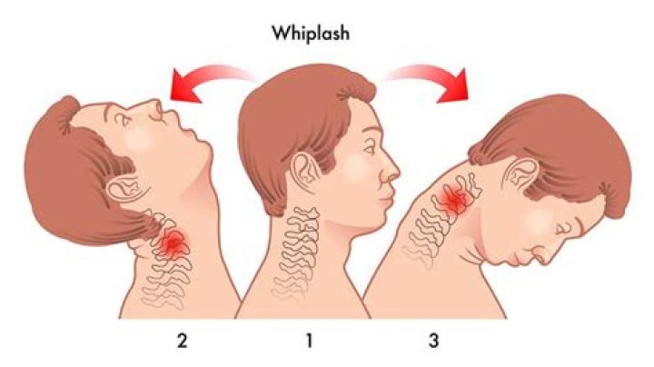 Can whiplash come back?