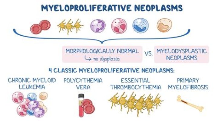Can you cure myeloproliferative neoplasms?
