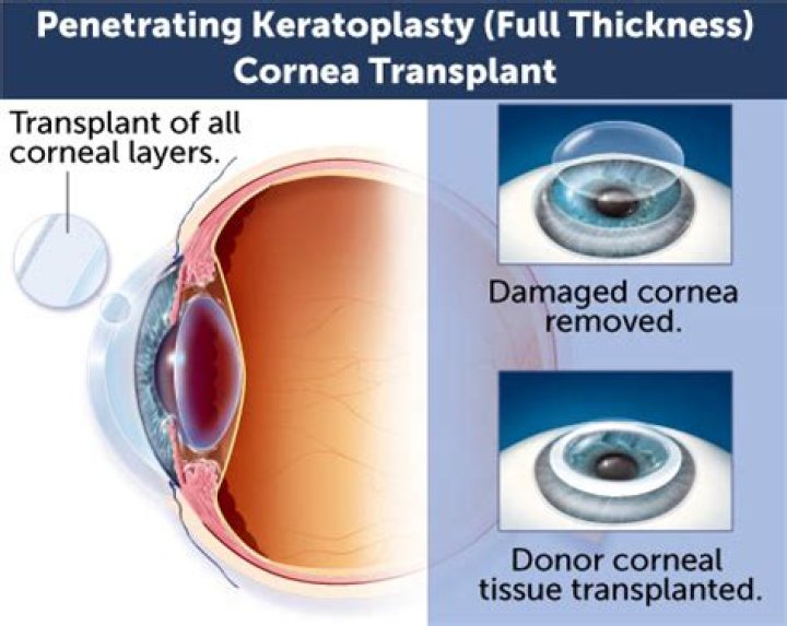 Can you see after a corneal transplant?