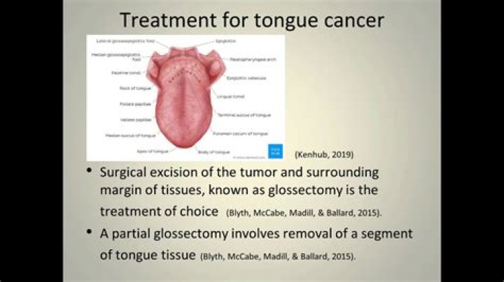 Can you speak after glossectomy?