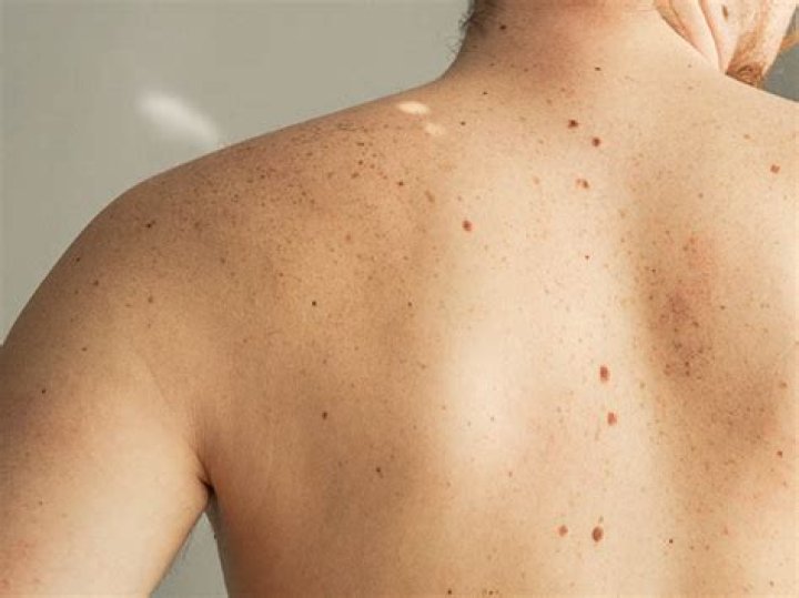 Could a freckle be skin cancer?