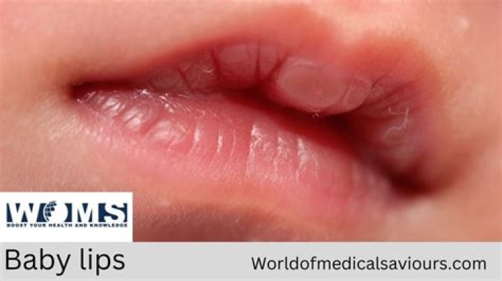 Do babies lips get chapped?