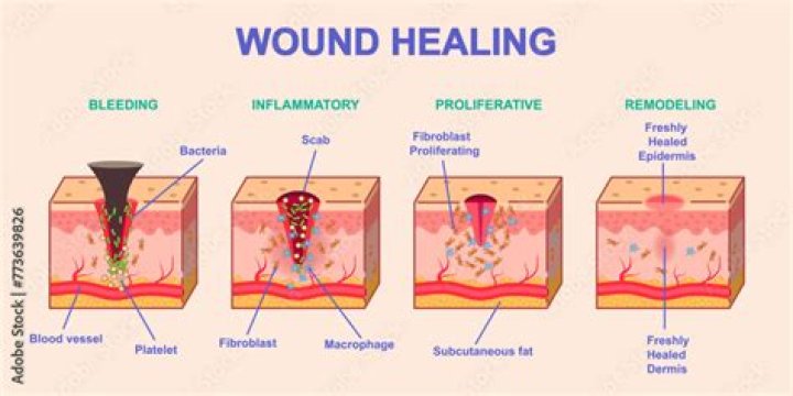 Do epidermal wounds bleed?