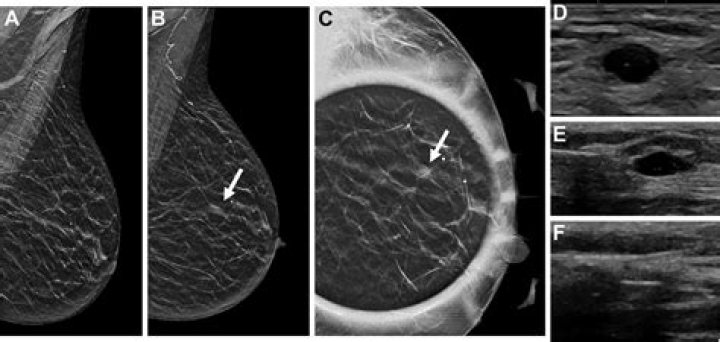 Do fibrocystic breasts go away?