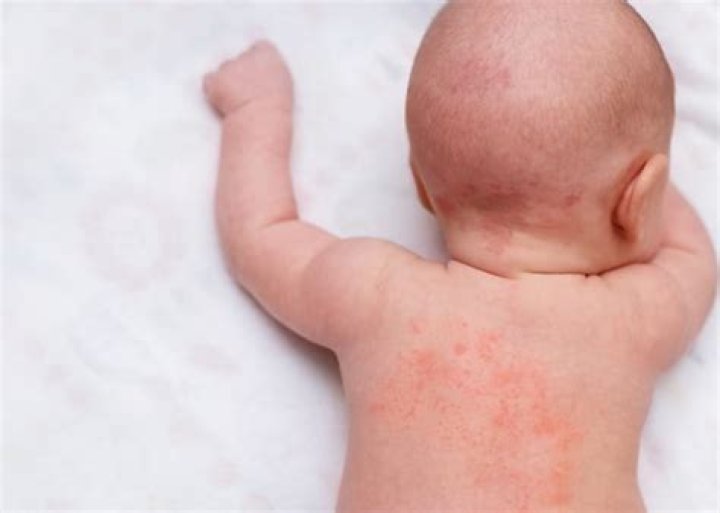 Do flat spots on babies go away?