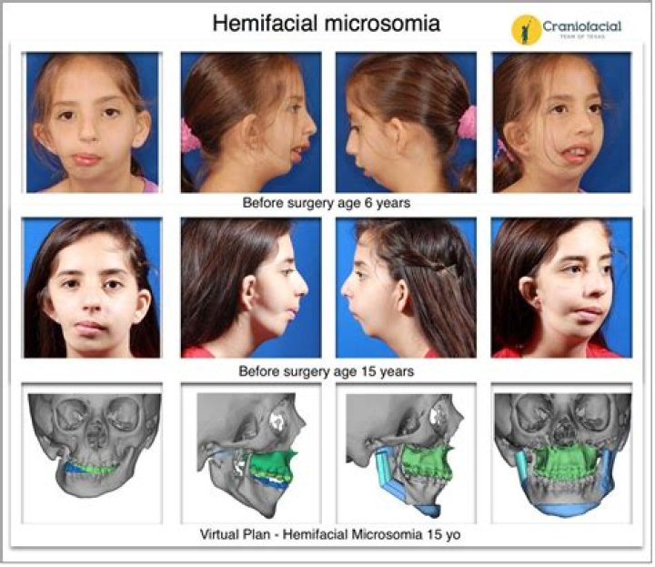 Do i have hemifacial microsomia?