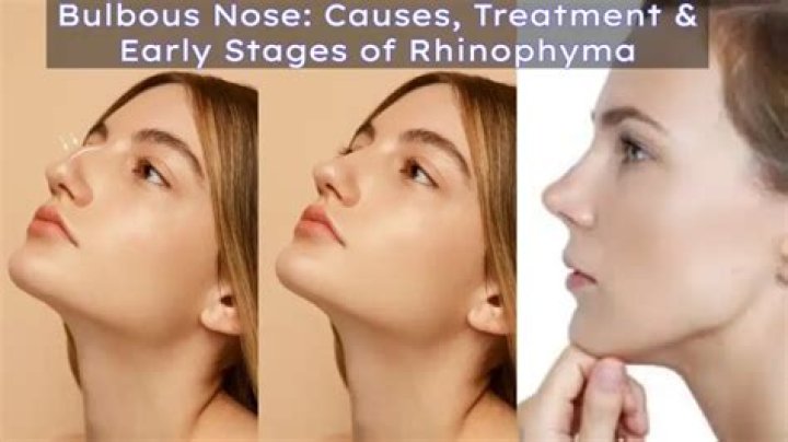 Do i have rhinophyma?