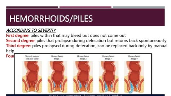 Do numbness cause hemorrhoids?