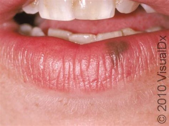 Do oral melanotic macules go away?