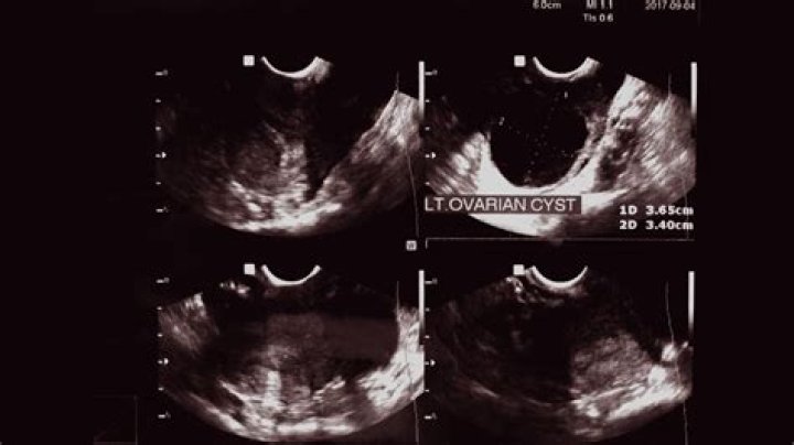 Do ovarian cysts cause discomfort?