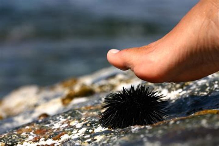 Do sea urchins sting?