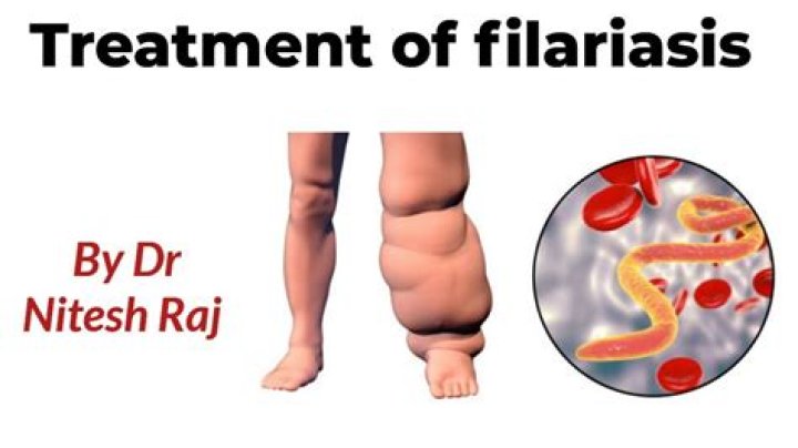 Do you get filariasis?