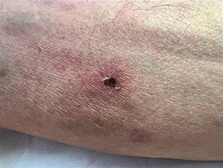 Do you get typhus?