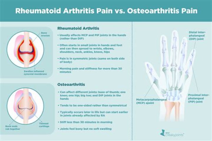 Does a rheumatologist treat osteoarthritis?
