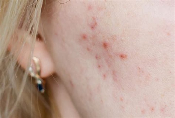 Does cystic acne itch?