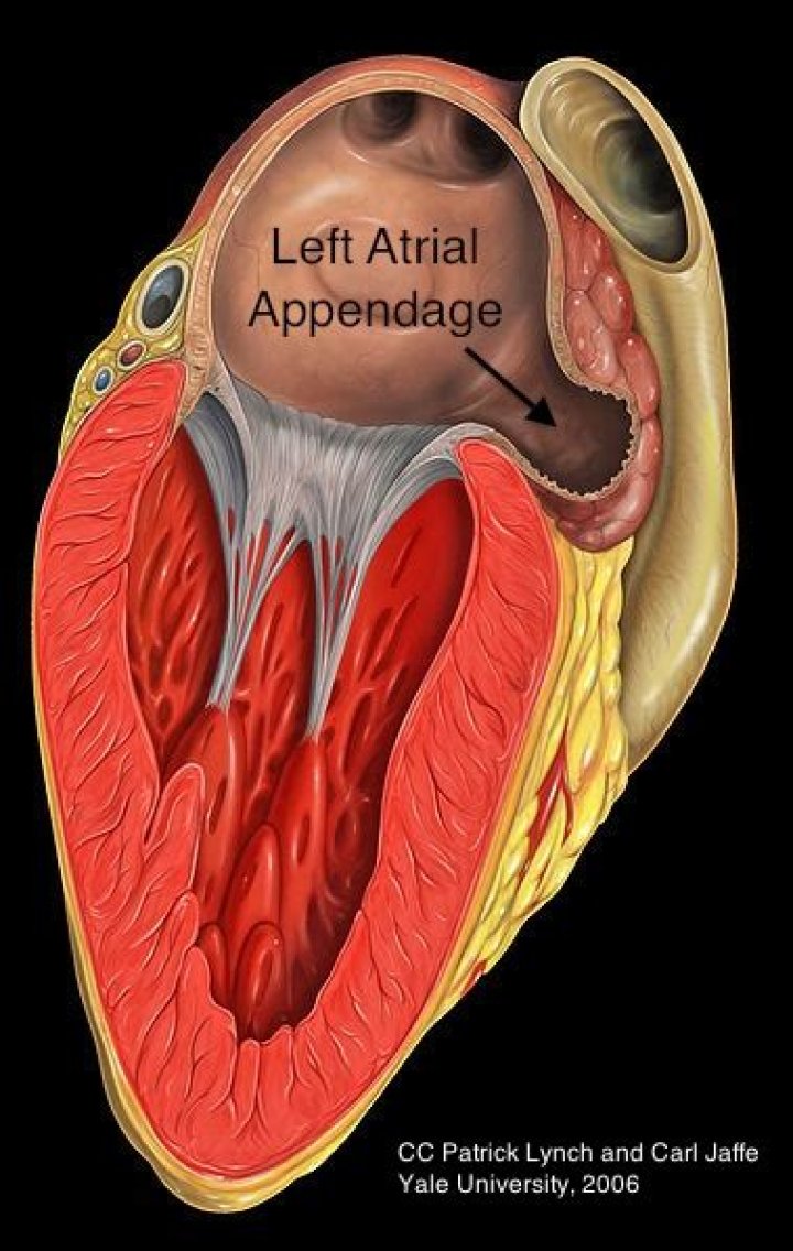 Does everybody have a left atrial appendage?