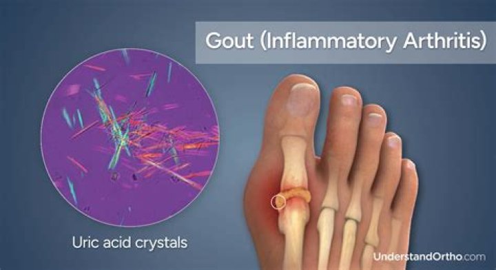 Does gouty arthritis cause fever?