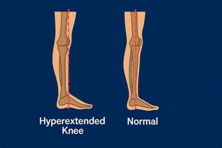 Does your knee swell when you hyperextend it?