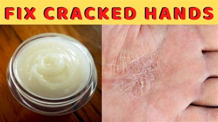 For dry chapped hands?