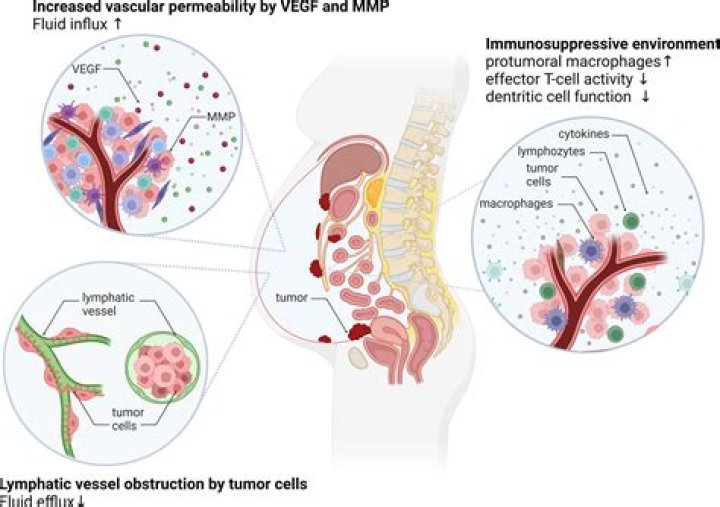 Has anyone ever survived ascites?