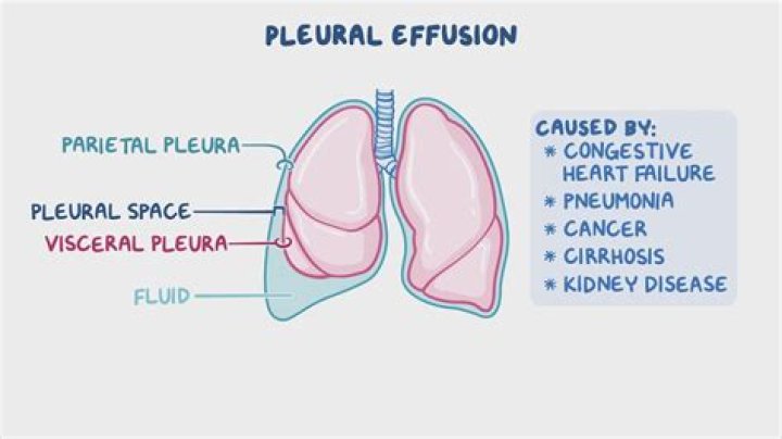 How ascites causes pleural effusion?