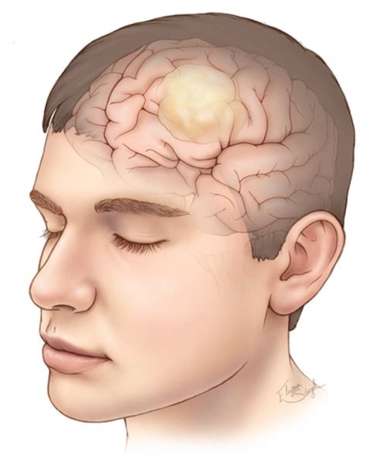 How does glioma kill you?