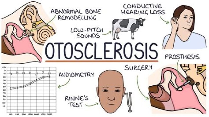 How fast does otosclerosis progress?