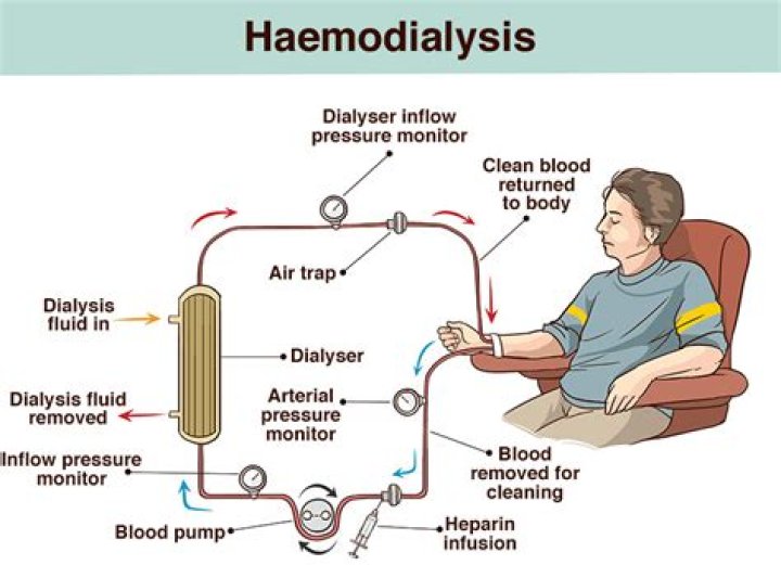 How haemodialysis is done?