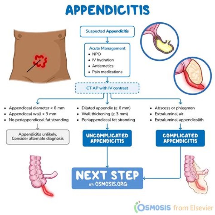 How intense is appendicitis pain?