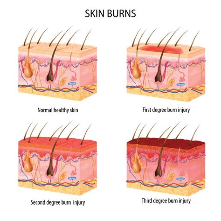 How long are burns painful?