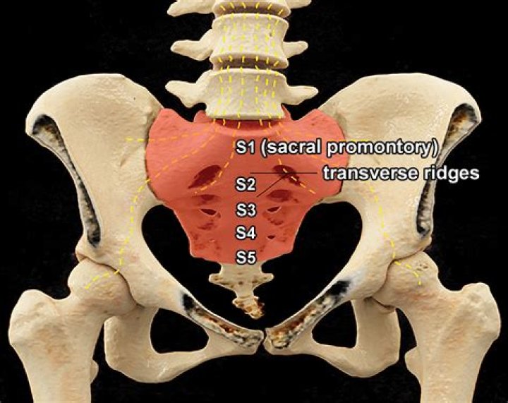 How serious is a fractured sacrum?