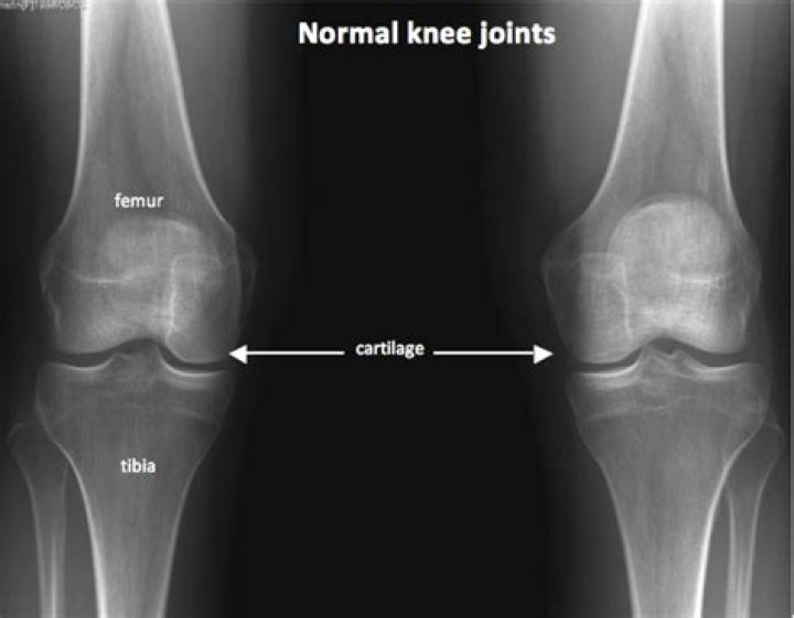 How thick is normal knee cartilage?