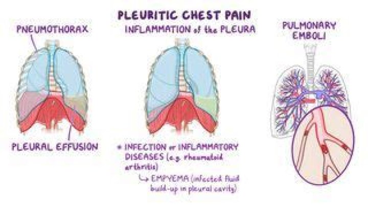 How to help pleurodynia?