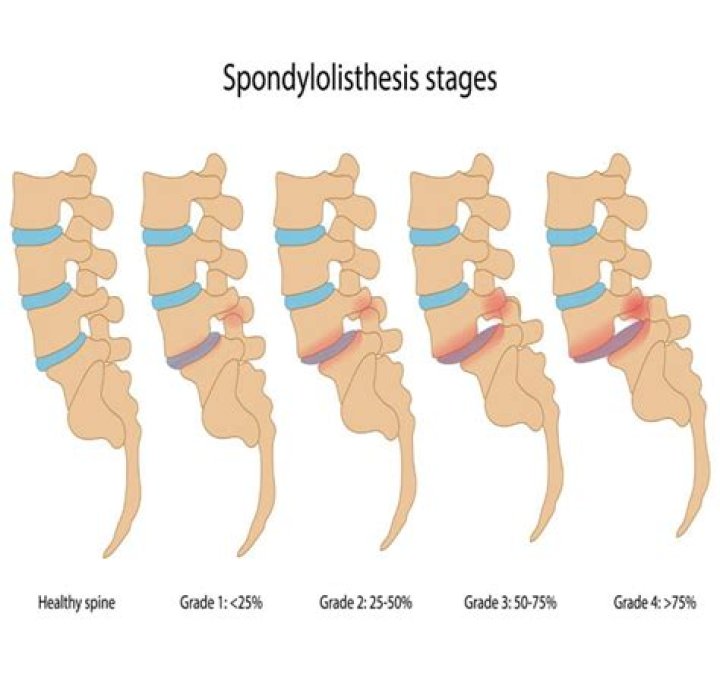 How to treat isthmic spondylolisthesis?