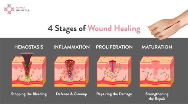 How to treat skin maceration?