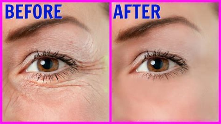 How wrinkles can be removed?