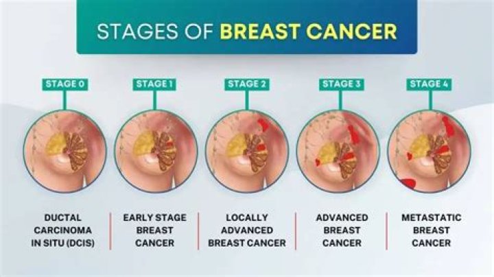 In cancer how many stages are there?