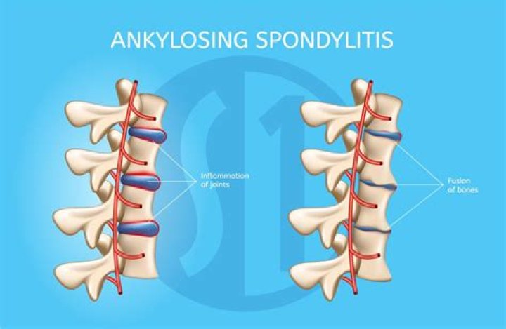 Is ankylosis the same as ankylosing spondylitis?