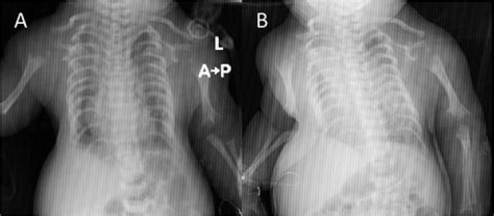 Is asphyxiating thoracic dystrophy fatal?